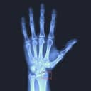 Hand x-ray showing a fracture of the wrist
