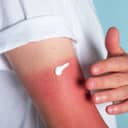 Close-up of a man applying cream to sunburned skin on his arm.