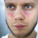Man with butterfly rash which is a key symptom of lupus